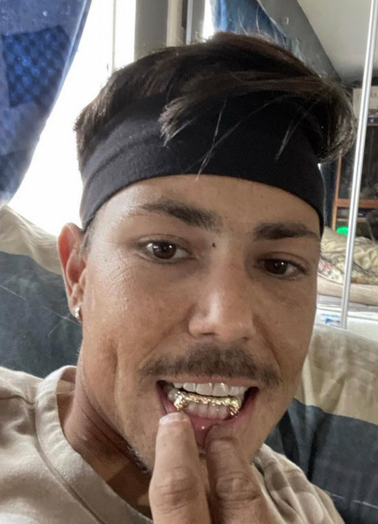 The Bridge - Yellow Gold 2 Teeth Cap, 6 Tooth Bridge